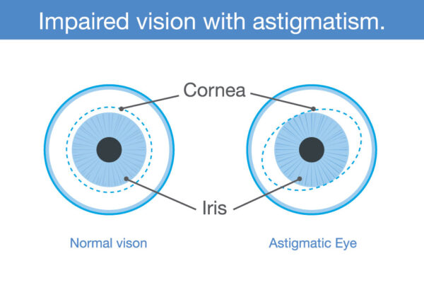 ACUVUE OASYS FOR ASTIGMATISM (MONTHLY TORIC) (3)